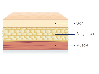 Diagram of skin layer for location on where to self-administer Hizentra